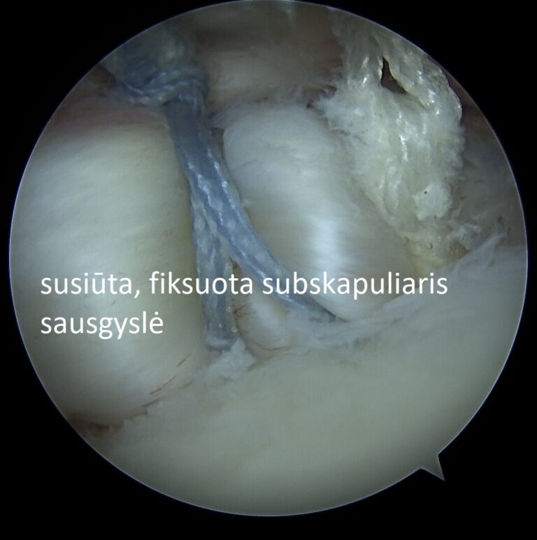 subskapuliaris fiksacija