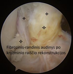 fibrozinis audinys po kryzminio rekonstrukcijos