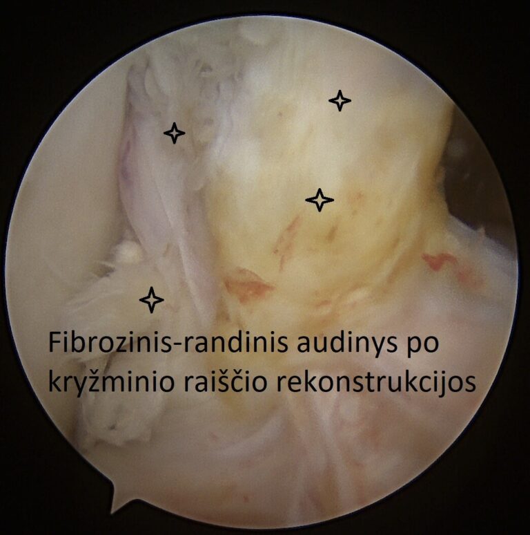 fibrozinis audinys po kryzminio rekonstrukcijos