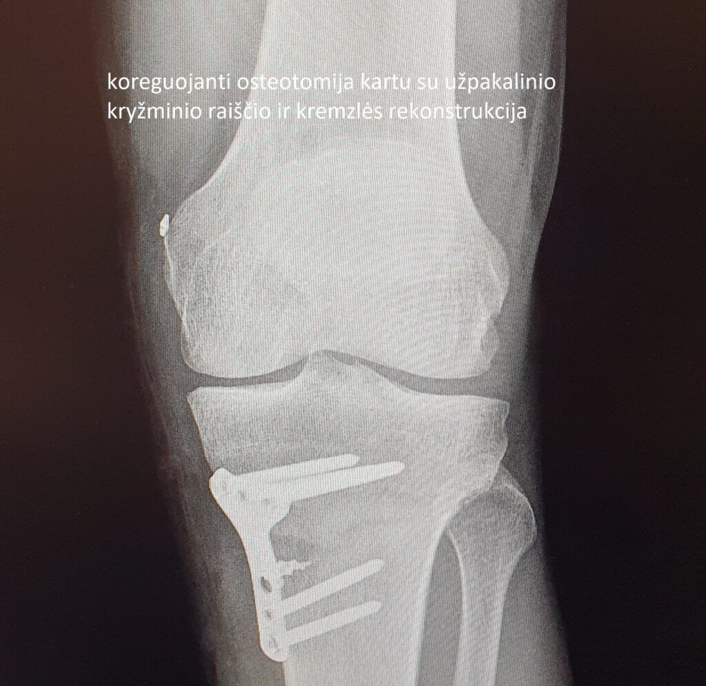 Blauzdikaulio osteotomija (HTO): pacientų atranka, operacijos planavimas, gydymas ir ilgalaikiai rezultatai 2 HTO
