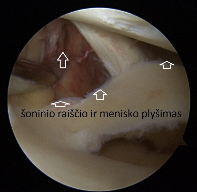 LCL ir menisko plysimas