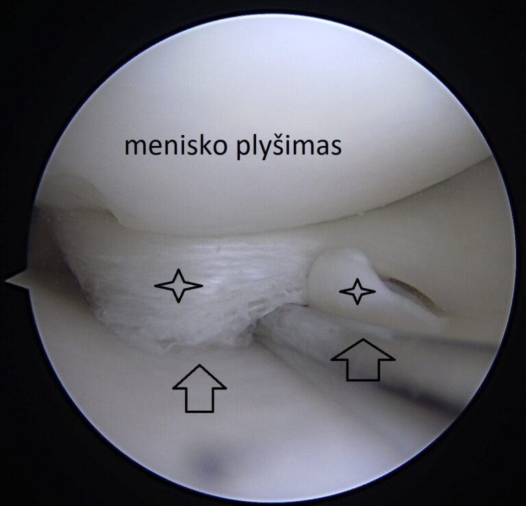 menisko plysimas 1