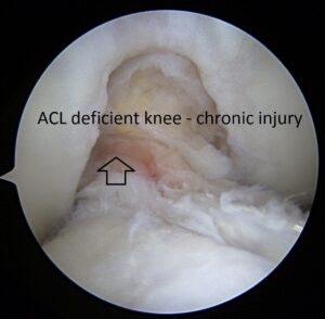 ACL rupture