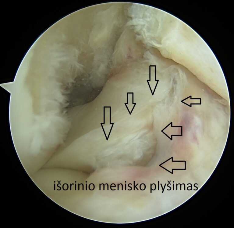 isorinio menisko plysimas