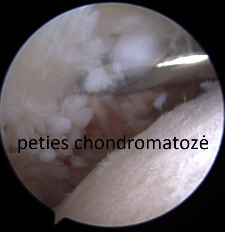 peties chondromatoze R.Gudas