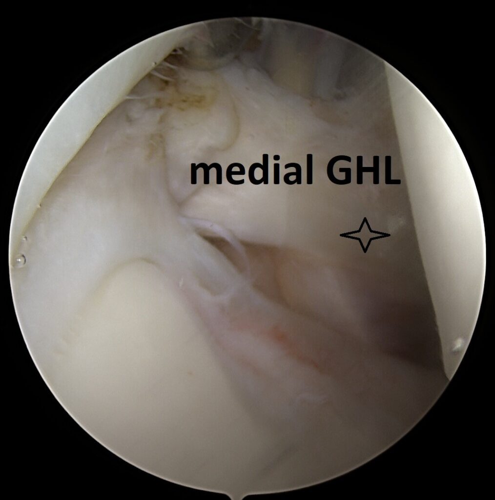 medial GHL shoulder
