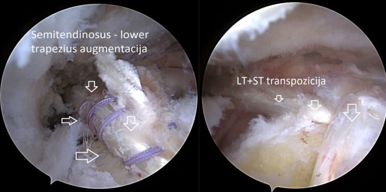 LT transfer 1