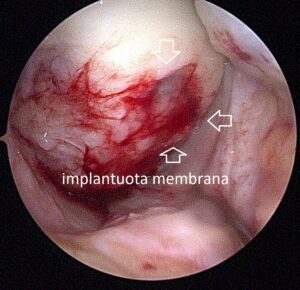 implantuota membrana