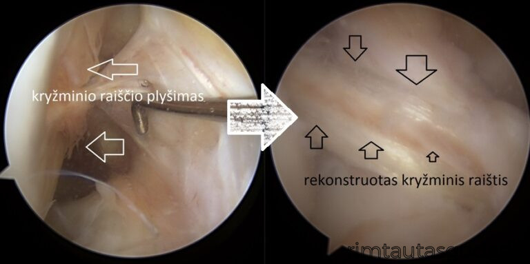 kryzminio raiscio plysimas rekonstrukcija