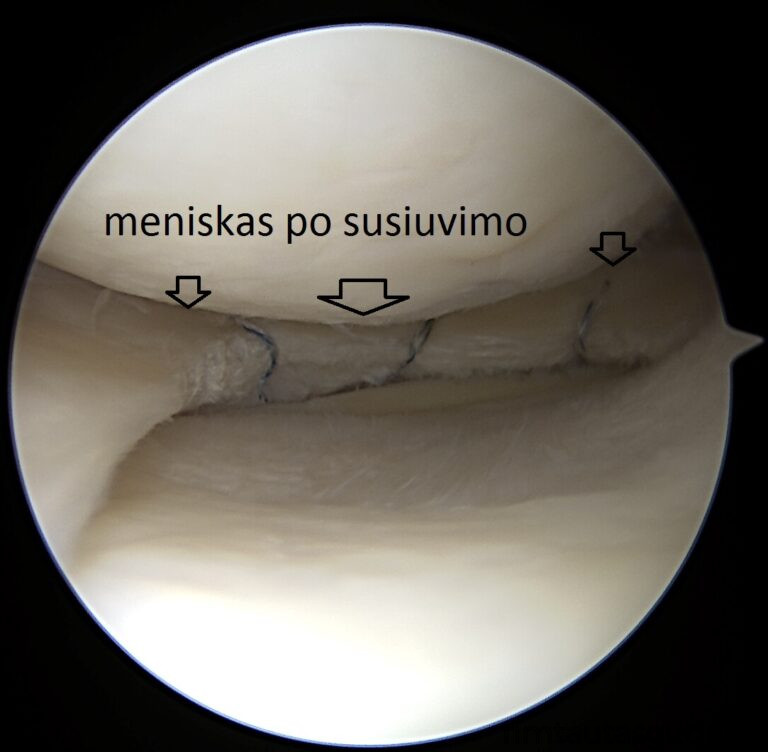 susiutas meniskas