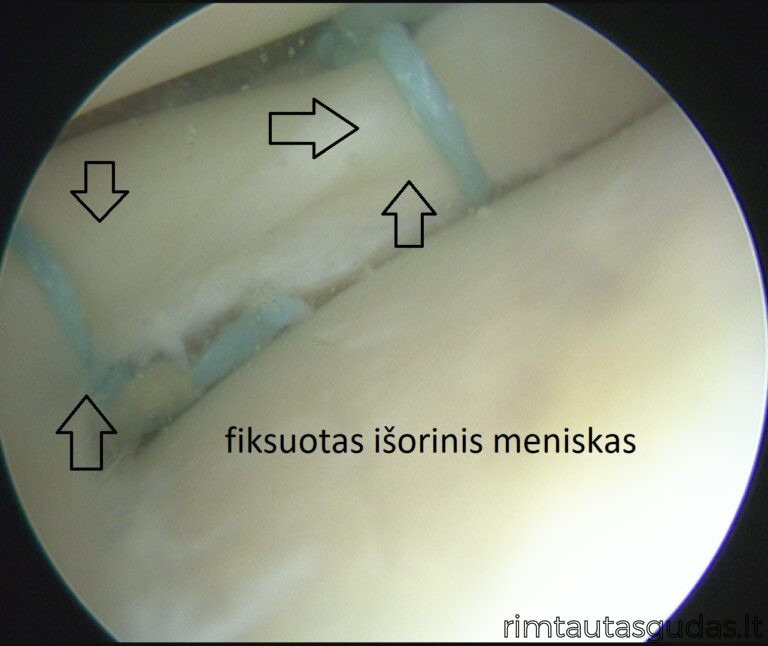 fiksuotas isorinis meniskas