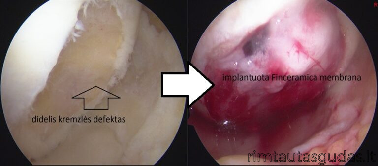 finceramica scaffold implantation