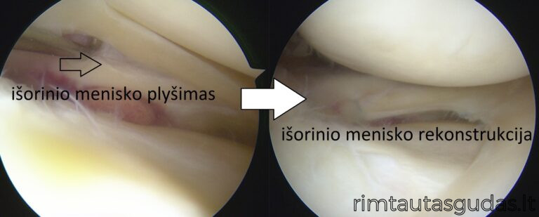 menisko rekonstrukcija 2