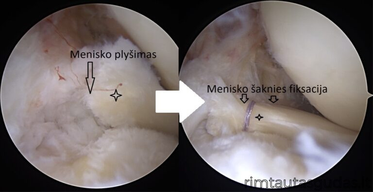 menisko saknies susiuvimas