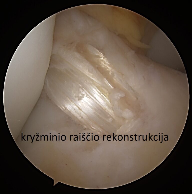 Karabinas Karabinss karabinas Arthroscopy Knee 2023 06 15 083206 Gudas Rimtautas Still 006