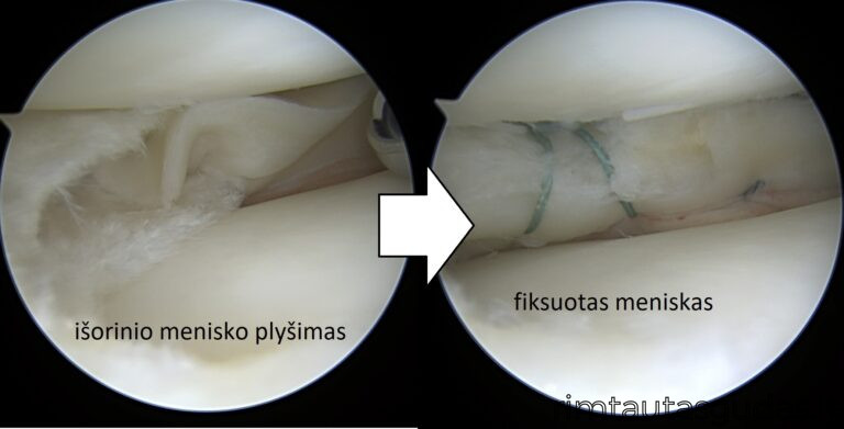 isorinio menisko susiuvimas