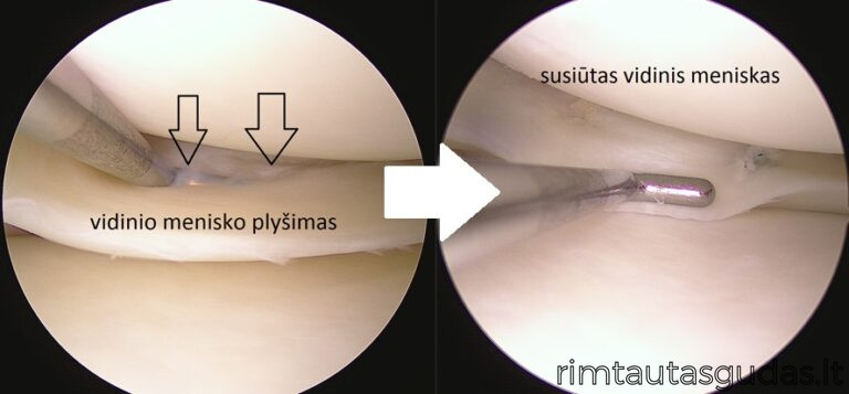 vidinio menisko susiuvimass