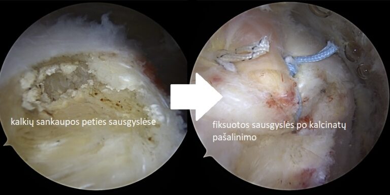 kalkejantis tendinitas siuvimas