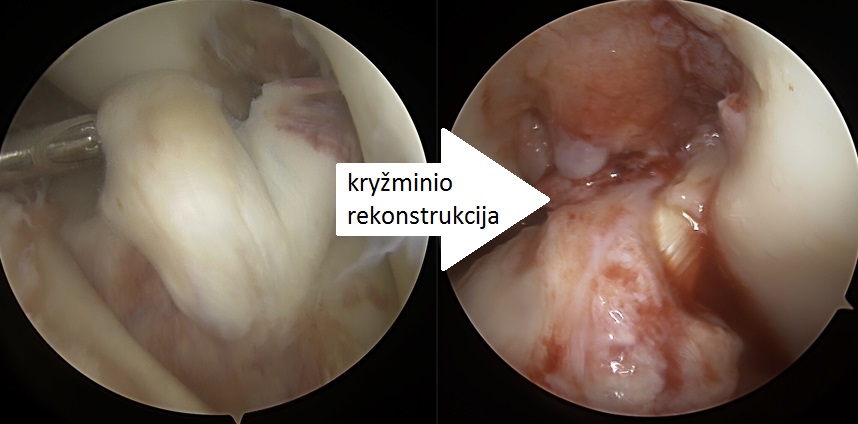 Kryžminio raiščio rekonstrukcija