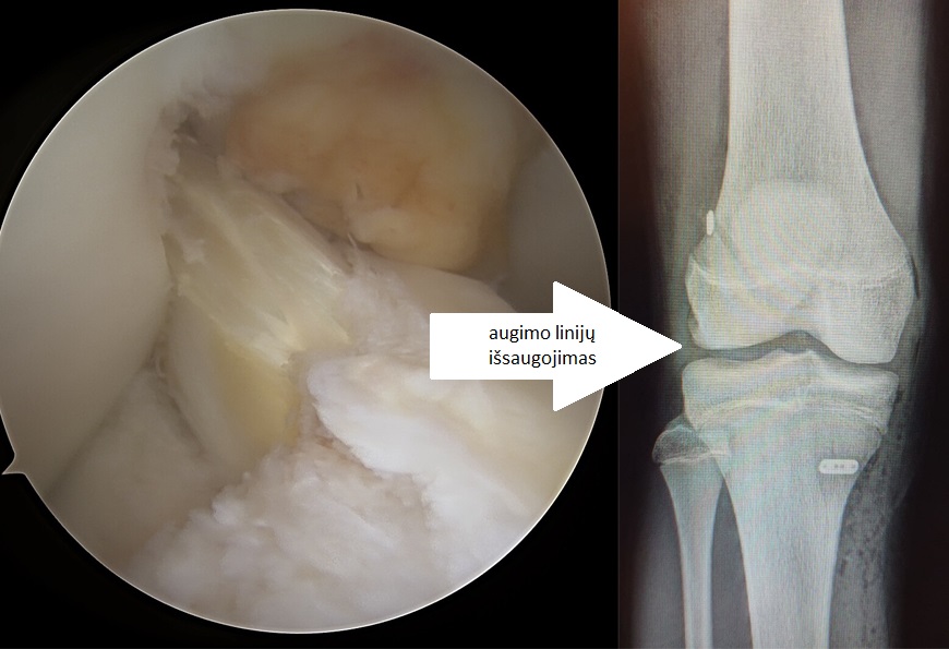Menisko plyšimai kartu kryžminio trauma vaikams