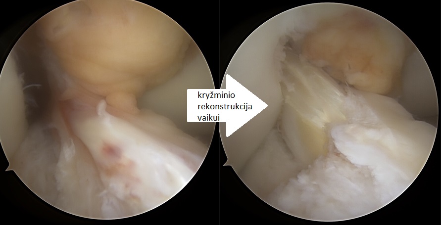 Menisko plyšimai kartu kryžminio trauma vaikams