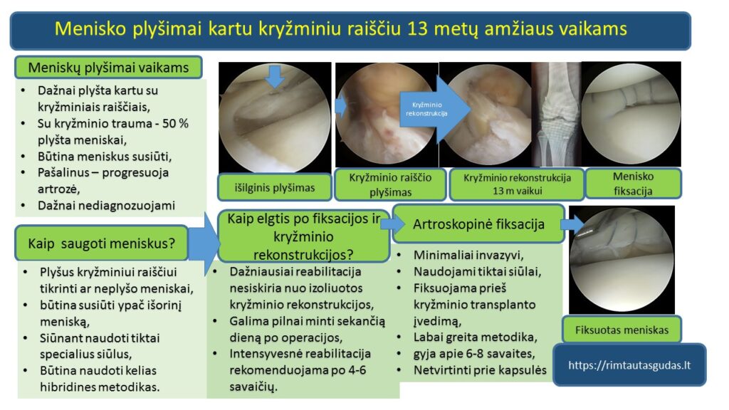 meniskai su kryzminiu vaikams R.Gudas