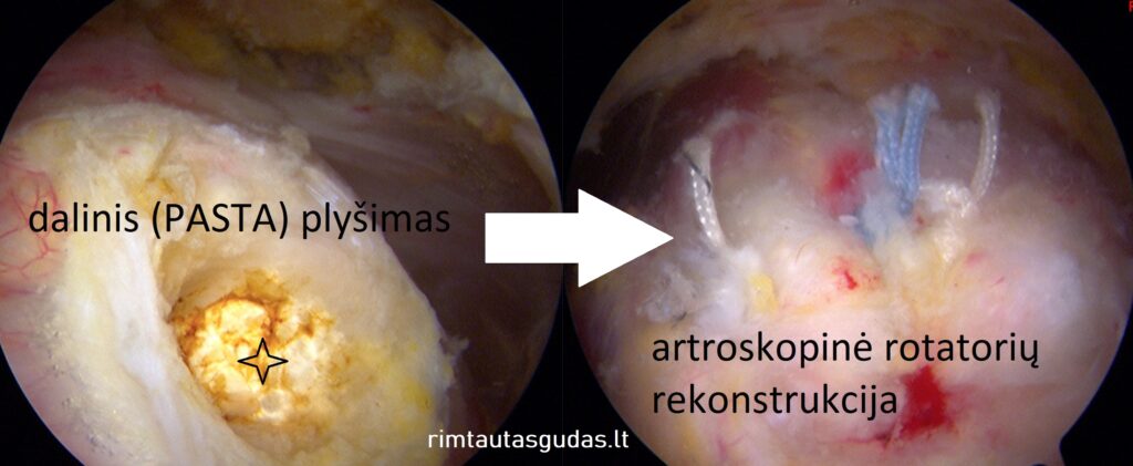 Dalinis peties rotatorių ir bicepso sausgyslės plyšimas