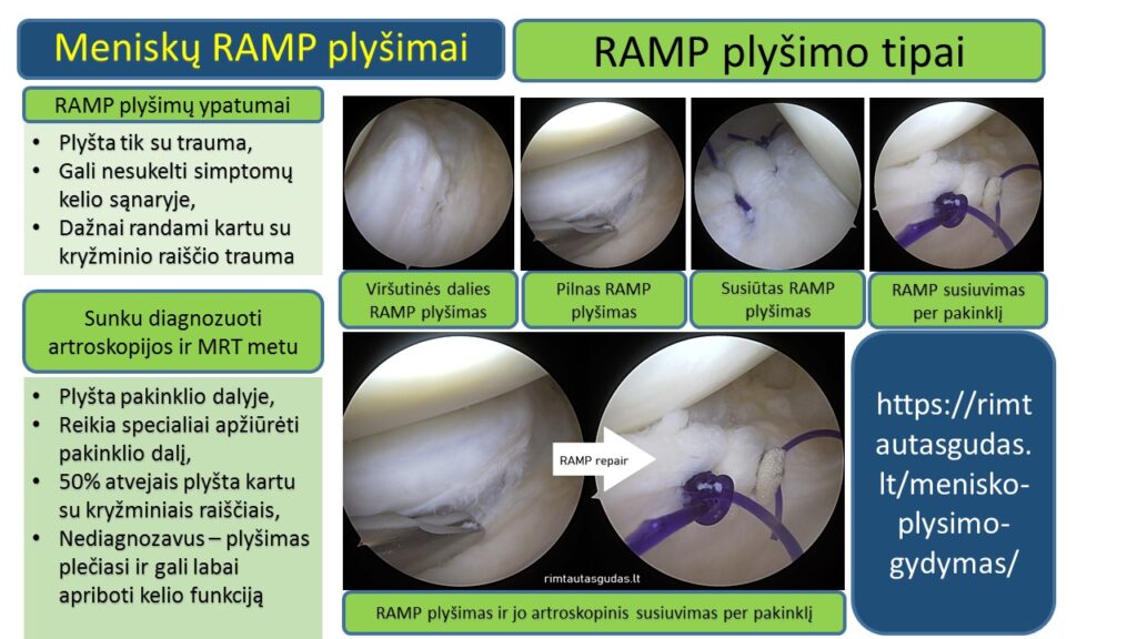 RAMP menisko plysimai