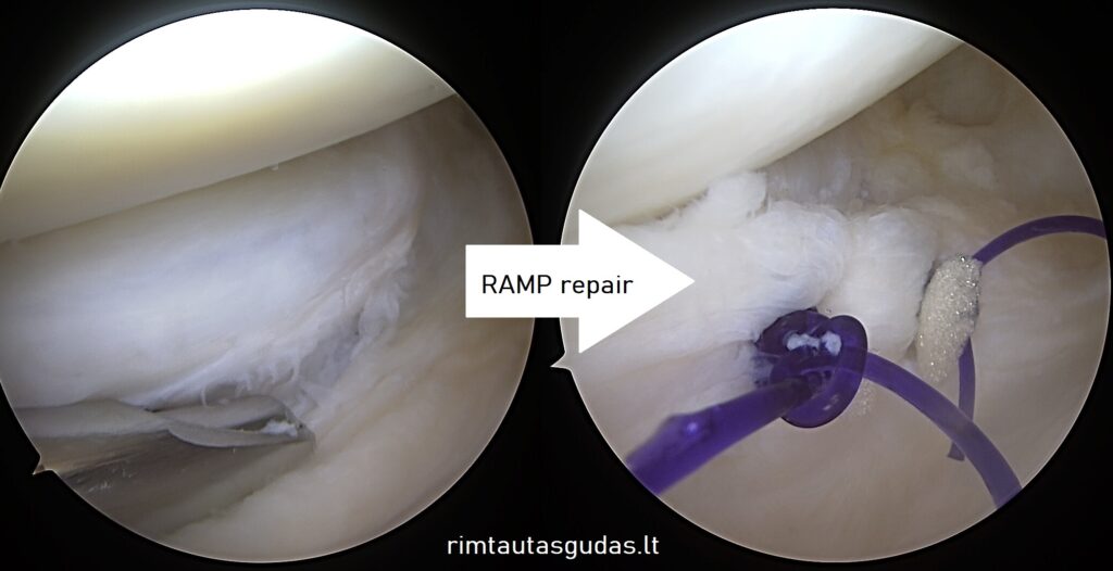 Kaip atliekama menisko artroskopinė operacija