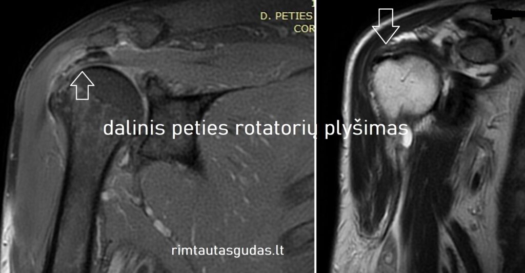 Dalinis peties rotatorių ir bicepso sausgyslės plyšimas