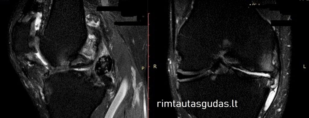 osteoartroze kelio