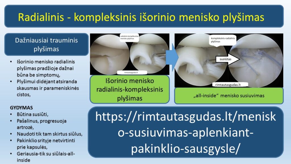 radialinio menisko susiuvimas R.Gudas