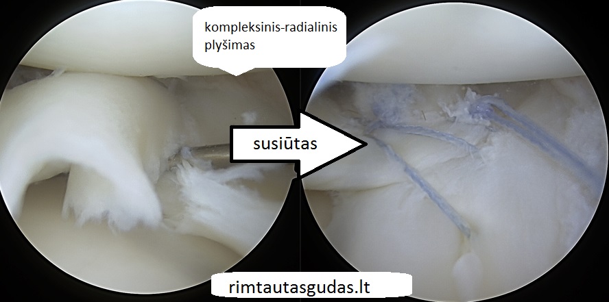 Radialiniai - kombinuoti menisko plyšimai