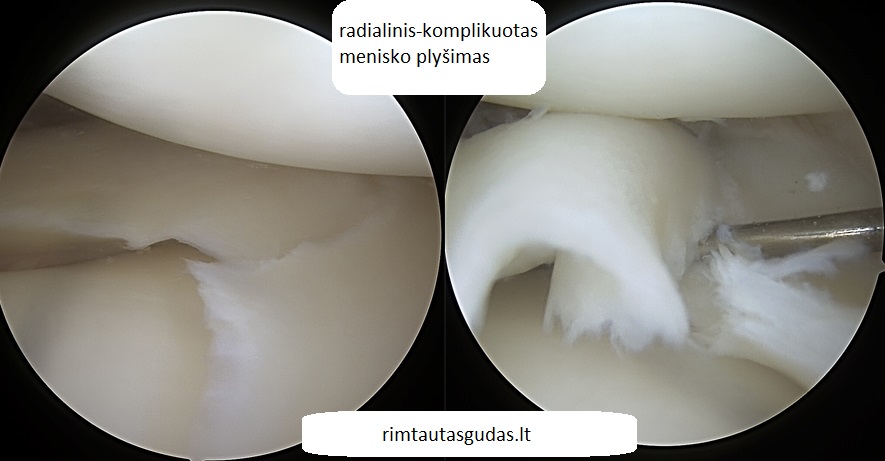 Radialiniai - kombinuoti menisko plyšimai