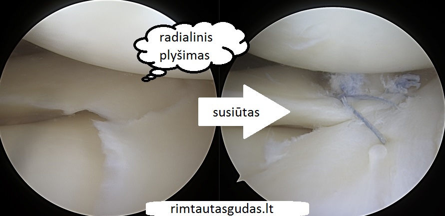 Radialiniai - kombinuoti menisko plyšimai