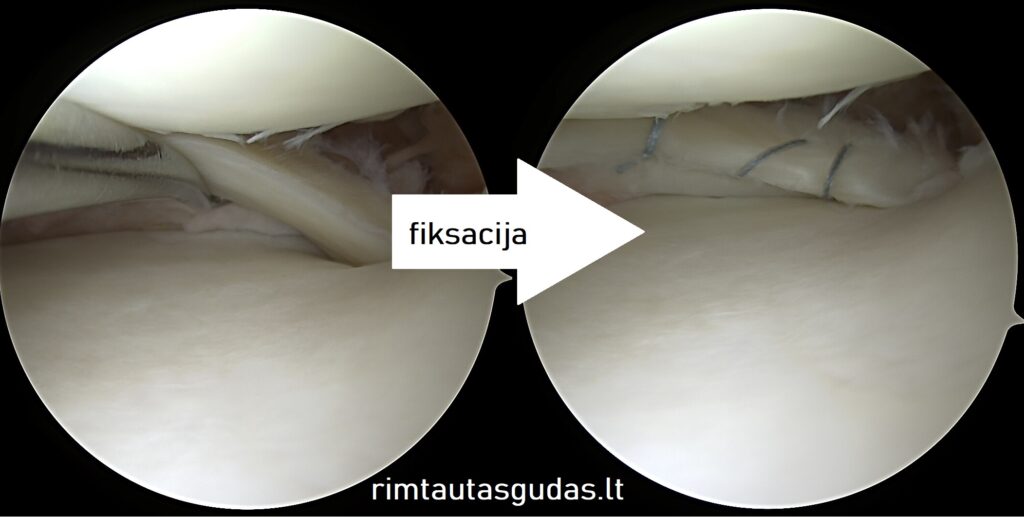 Nelaiminga kelio sąnario triada