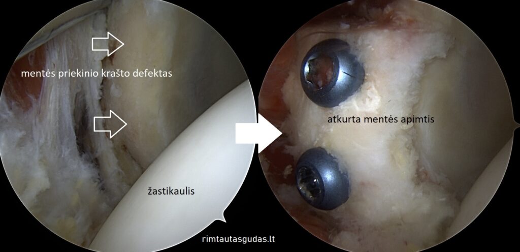 Kaip atliekama artroskopinė peties rekonstrukcija (@Latarjet)