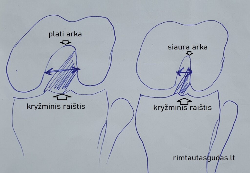 Moterims – didesnė kryžminio raiščio traumos rizika