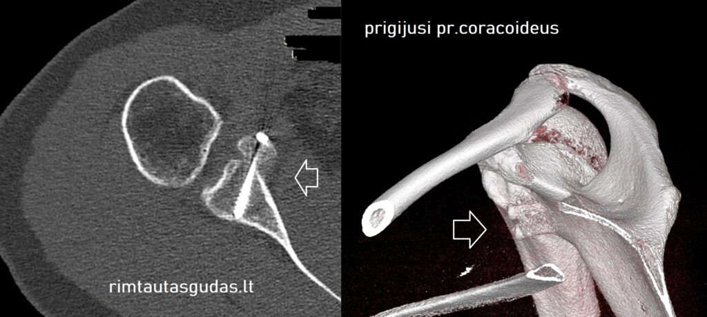 Artroskopinis pr.coracoideus perkėlimas