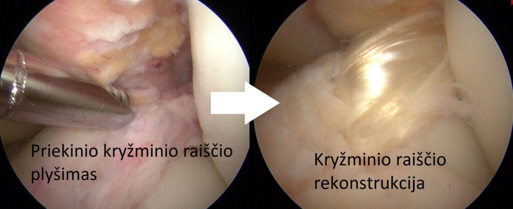 Kryžminio raiščio trauma vaikams