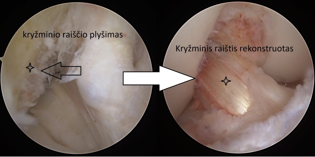 Moterims – didesnė kryžminio raiščio traumos rizika