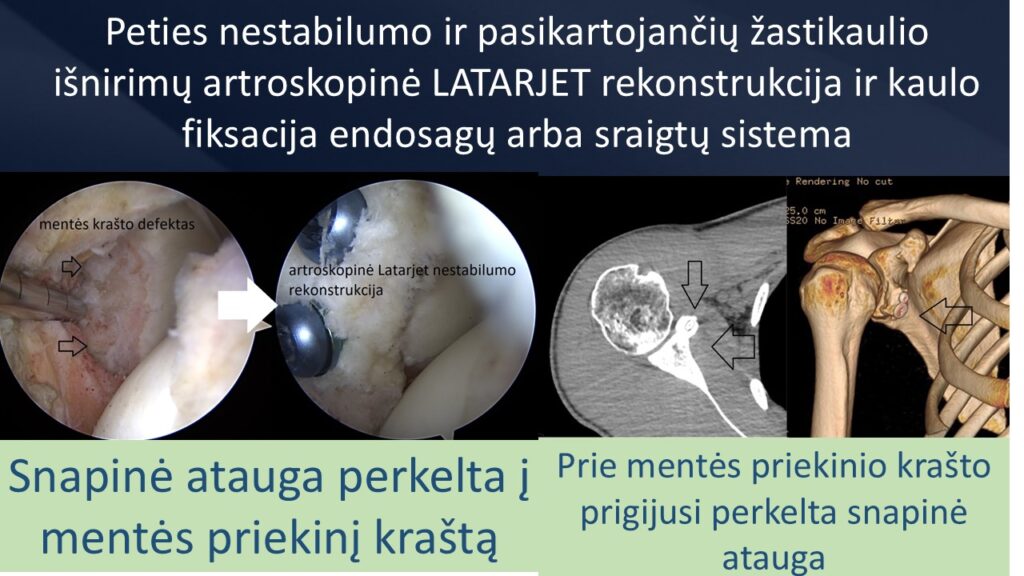 Latarjet artroskopine operacija R.Gudas