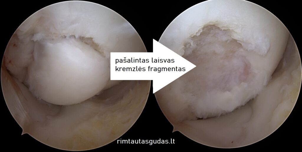 Sąnario kremzlės defekto atstatymas