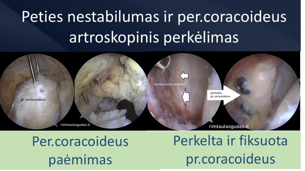 Pr.coracoideus perkelimas R.Gudas