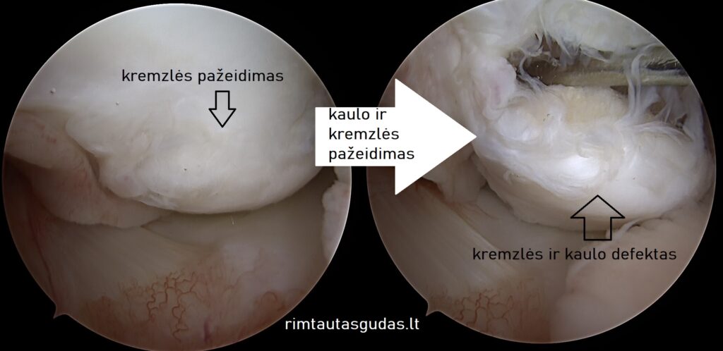 Sąnario kremzlės defekto atstatymas