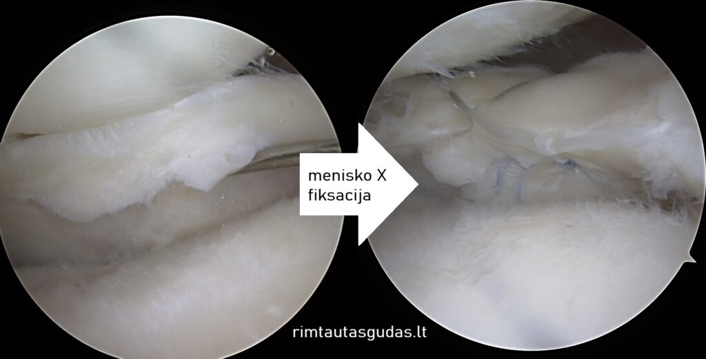 Menisko X tipo siūlė