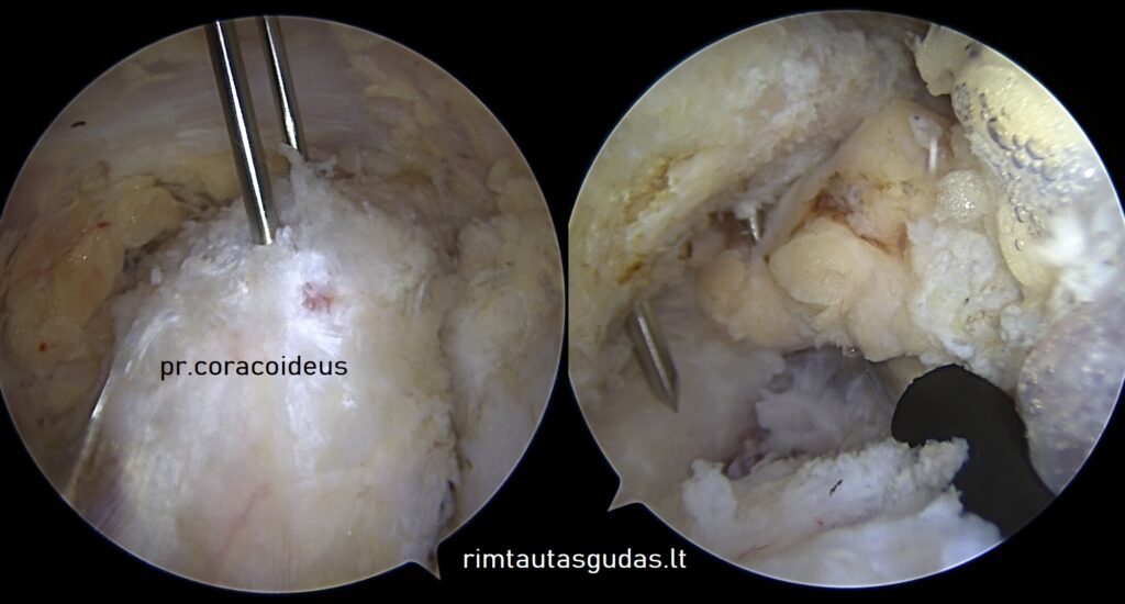 Artroskopinis pr.coracoideus perkėlimas