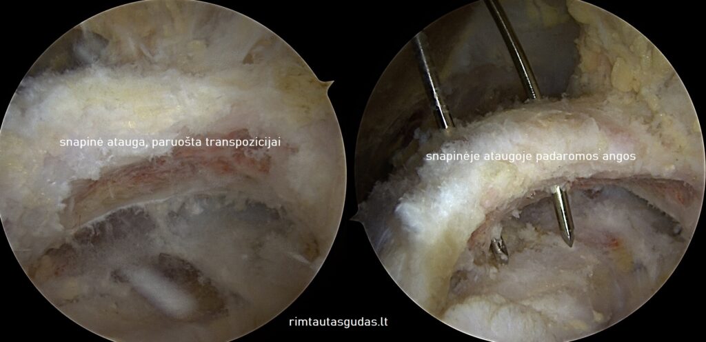Kaip atliekama artroskopinė peties rekonstrukcija (@Latarjet)