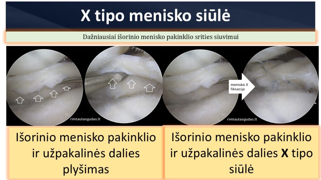 menisko X siule