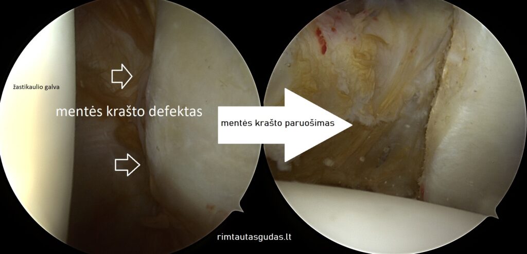 Kaip atliekama artroskopinė peties rekonstrukcija (@Latarjet)